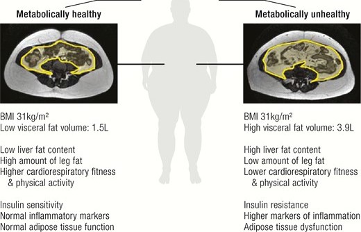 diagram showing difference between metabolically healthy and unhealthy obesity
