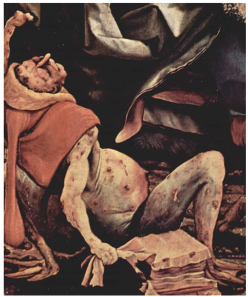 painting of man suffering from ergotsim