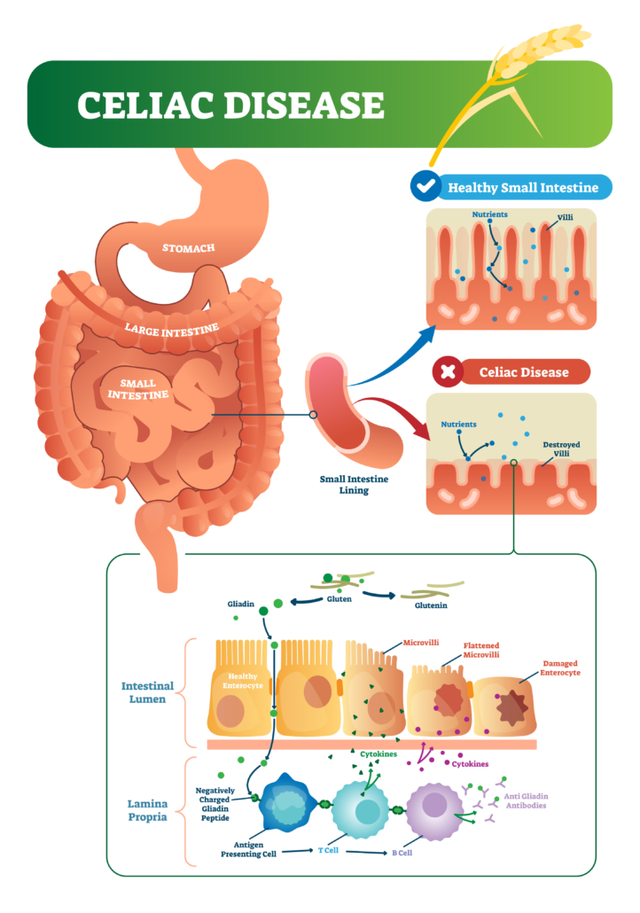 Celiac disease vector illustration. Labeled diagram with its structure. Autoimmune illness in stomach and intestine. Scheme with nutrients, healthy and destroyed villi.