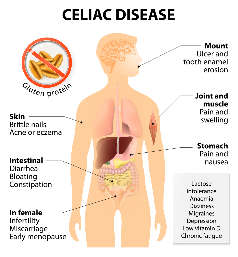 Coeliac disease or celiac disease or celiac sprue. Signs and Symptoms. Human silhouette with highlighted internal organs