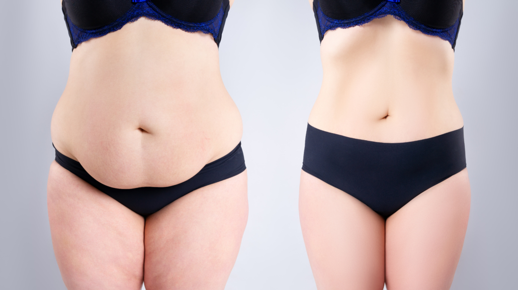 Woman's belly before and after weight loss on gray background, plastic surgery concept