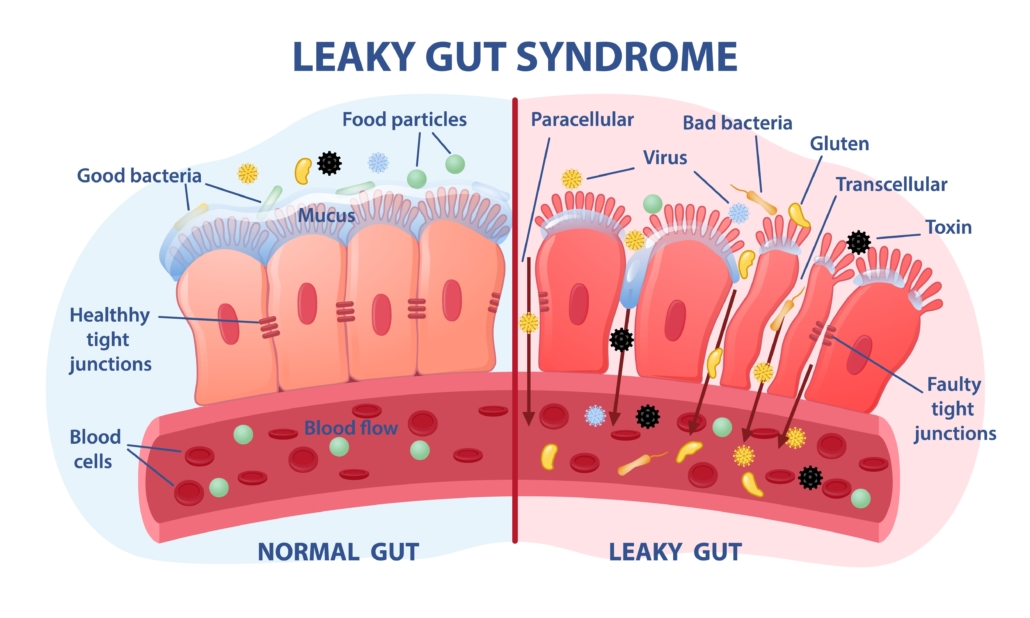 Leaky gut Syndrome concept. Comparison of healthy organ and inflamed tissue cells. Diseases of gastrointestinal tract. Toxins and viruses. Cartoon flat vector illustration isolated on white background