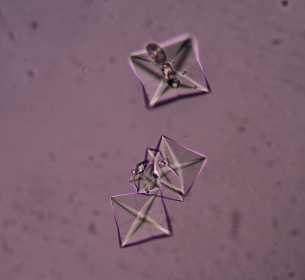 calcium oxalate crystal in urine analysis.
