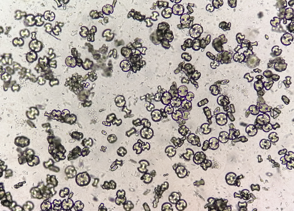 Microscopic image showing calcium oxalate monohydrate, uric acid
