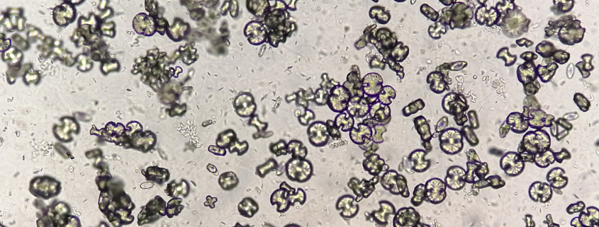 Microscopic image showing calcium oxalate monohydrate, uric acid