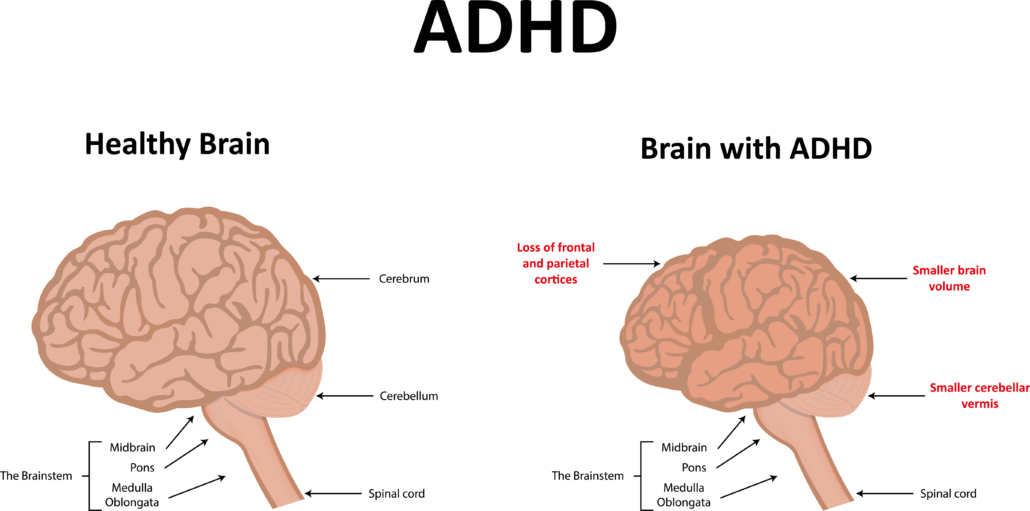 diagram of normal and ADHD brain