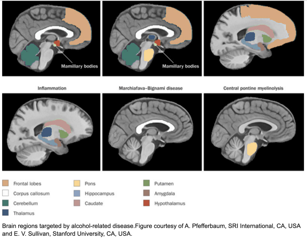 brain images showing effects of alcohol